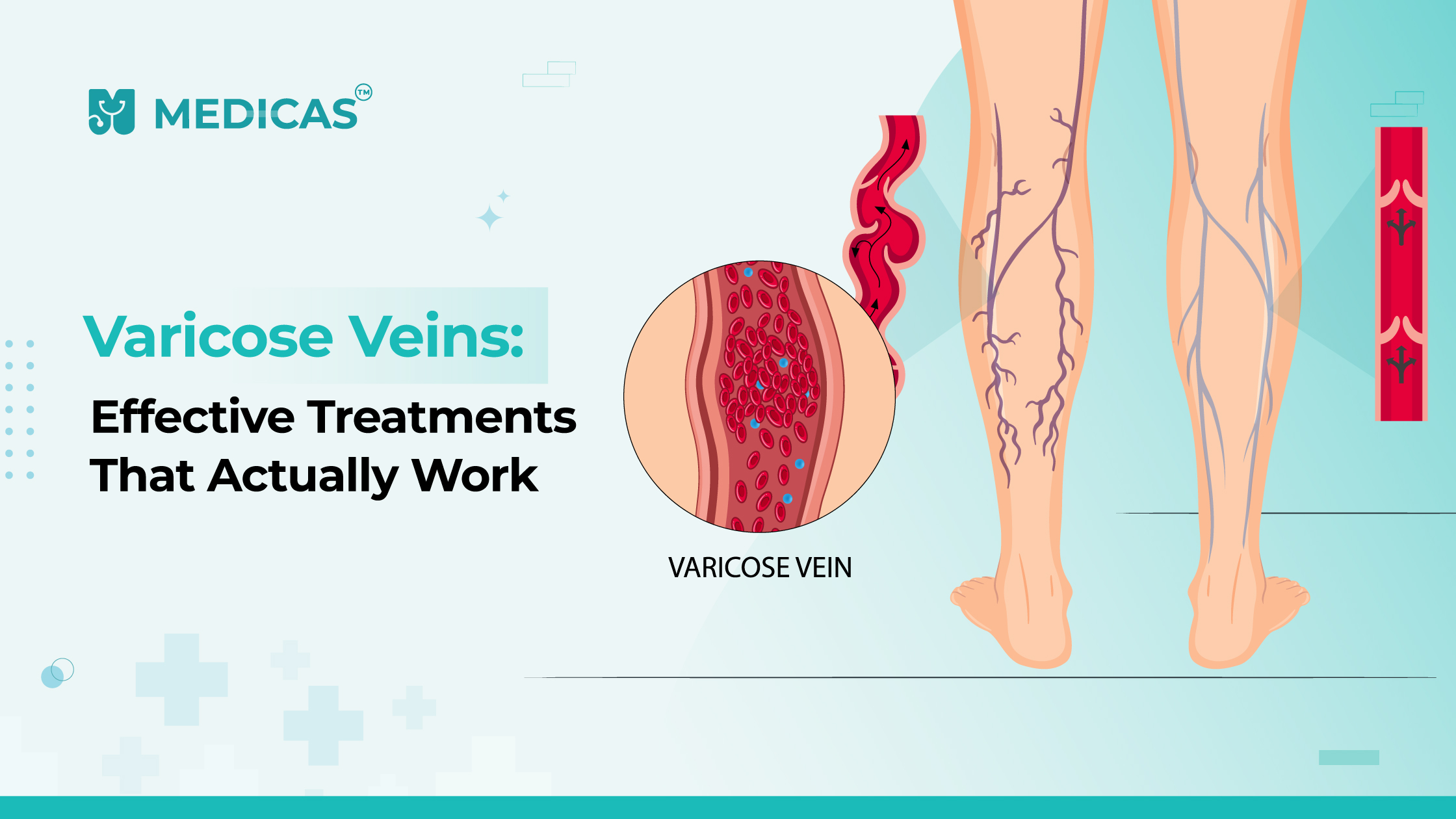 Varicose Veins Treatment Options: What Really Works